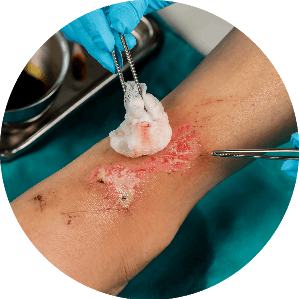 woundcare dressing wound care dressing