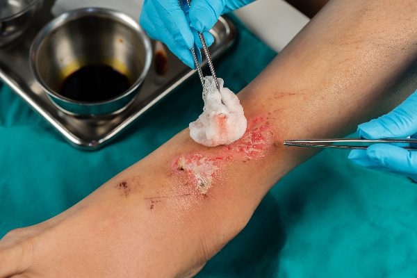 complex_wound_dressing complex wound dressing