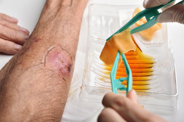 arm wound treatment Arm wound treatment